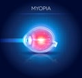 Myopia eyesight disorder Royalty Free Stock Photo