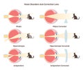 Myopia, hyperopia and astigmatism. Common vision disorders and its correction