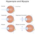 Myopia and Hyperopia Royalty Free Stock Photo