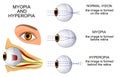 Myopia and hyperopia