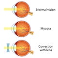 Myopia and myopia corrected by a minus lens. Royalty Free Stock Photo