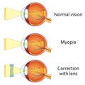 Myopia and myopia corrected by a minus lens. Royalty Free Stock Photo