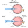 Myopia structure diagram medical science