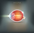 Myopia, vision disorder