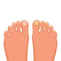 Nail disease. Onychomycosis concept. Fungal nail infection. Vector.