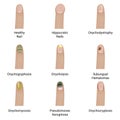 Nail diseases vector illustration design. Royalty Free Stock Photo