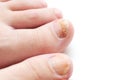 Nail fungus on the big toe of the foot Royalty Free Stock Photo