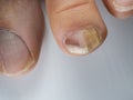 Nail infections caused by fungi such as: onychomycosis also known as tinea unguium. Caused by dermatophytes and yeasts