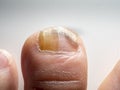 Nail infections caused by fungi such as: onychomycosis also known as tinea unguium. Caused by dermatophytes and yeasts