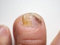 Nail infections caused by fungi such as: onychomycosis also known as tinea unguium. Caused by dermatophytes and yeasts