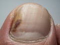 Nail infections caused by fungi such as: onychomycosis also known as tinea unguium. Thumb infection