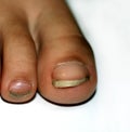 Nails on the feet, dirty. Ingrown toenails. Black dirty fingernails.