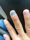 Nails that are injured from being caught in the door