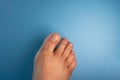 Nails of Man`s Foot with a fungus on blue background. Royalty Free Stock Photo