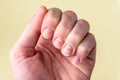 Nails with white spots on yellow background. Leukonychia, calcium deficit. Royalty Free Stock Photo