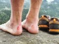 Naked male legs with horrible blister on peak. Injured rock climber heel