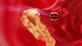 Nanobot finds and removes forming cholesterol plaque