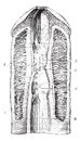 Narrowing of the urethra several consecutive blennorrhagias, vin