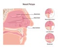 Nasal polyps. Noncancerous growths on the lining of the nose or sinuses.