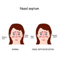 Nasal septum deviation Royalty Free Stock Photo