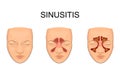 Nasal sinus. inflammation