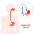 Nasogastric enteral feeding tube passed to stomach infographics Royalty Free Stock Photo