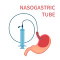 Nasogastric feeding system tube passed to stomach Royalty Free Stock Photo