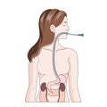 Nasogastric intubation medical science Royalty Free Stock Photo