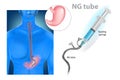 Nasogastric tube or NG tube