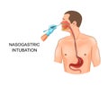 Nasogastric tube in the stomach