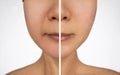 Nasolabial folds in a asian woman. Face close up. Before and after. Royalty Free Stock Photo