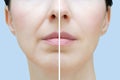 Nasolabial folds in Caucasian woman. Face close up. Before and after