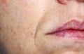 Nasolabial folds and enlarged pores on the female face. Skin care in 40 years