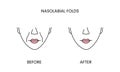 Nasolabial folds, laser cosmetology before procedure and after applying treatment line icon in vector. Illustration of a
