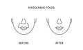 Nasolabial folds, laser cosmetology before procedure and after applying treatment line icon in vector. Illustration of a