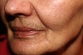 Nasolabial wrinkled fold on the skin of the face.