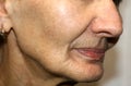 Nasolabial wrinkles. Wrinkles on the skin of the face. Flabby cheeks