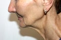 Nasolabial wrinkles. Wrinkles on the skin of the face of the neck. Flabby cheeks and neck