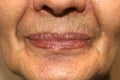 Nasolabial wrinkles. Wrinkles on the skin of the face of the neck. Flabby cheeks and neck