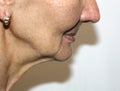 Nasolabial wrinkles. Wrinkles on the skin of the face of the neck. Flabby cheeks and neck