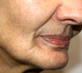 Nasolabial wrinkles. Wrinkles on the skin of the face of the neck. Flabby cheeks and neck