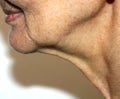 Nasolabial wrinkles. Wrinkles on the skin of the face of the neck. Flabby cheeks and neck