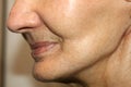 Nasolabial wrinkles. Wrinkles on the skin of the face of the neck. Flabby cheeks and neck