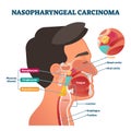 Nasopharyngeal carcinoma tumor, vector illustration Royalty Free Stock Photo