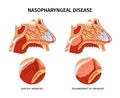 Nasopharyngeal Disease Poster