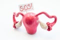 Natural anatomical 3D uterus with ovaries model with placard inscripted SOS referring to patient or doctor for help. Conceived for Royalty Free Stock Photo
