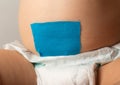 The navel is sealed with a blue plaster on the stomach of a child. Treatment of umbilical hernia in newborns, close-up Royalty Free Stock Photo