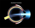 Nearsightedness eye disease Royalty Free Stock Photo