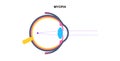 Nearsightedness eye disease Royalty Free Stock Photo