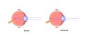 Normal eye and nearsightedness